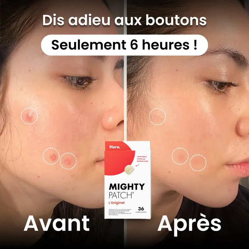 Mighty Patch - Patch anti-acne - YN