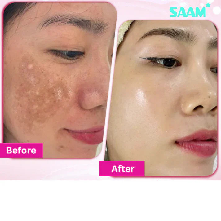 Yujia™ Melasma and Dark Spot Corrector Cream - YN